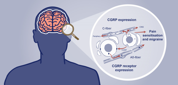 CGRP与偏头痛